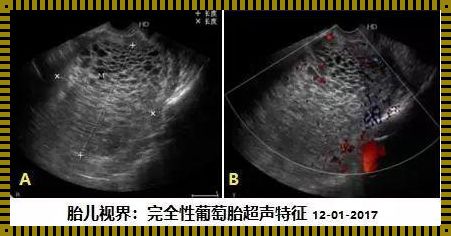 葡萄胎：疾病与怀孕的界限